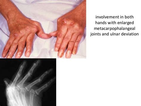 Ulnar deviations