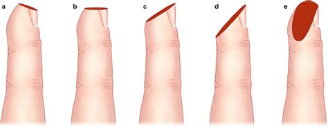 Repair of Fingertip Amputations | SpringerLink