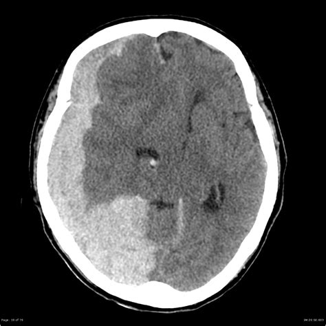 Subdural Hemorrhage CT Scan