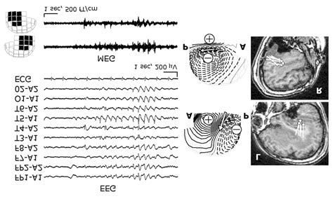 Epileptiform discharges in Case 1. EEG showed frequent bilateral... | Download Scientific Diagram