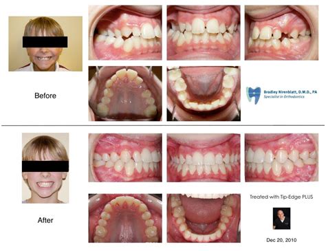 Posterior Crossbite Treated Without An Expander