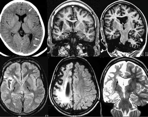 ABC Radiology Blog: Rasmussen's Encephalitis MRI Findings