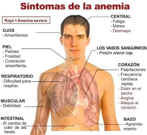 LA ANEMIA