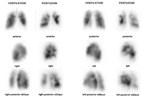 Frontiers | Lung Ventilation/Perfusion Scintigraphy for the Screening of Chronic Thromboembolic ...