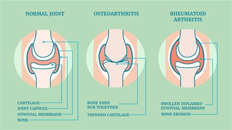 Key Differences Between Rheumatoid Arthritis and Osteoarthritis