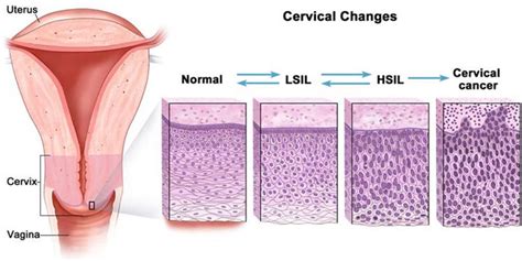 Squamous intraepithelial lesion, low grade, high grade, symptoms & treatment