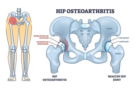 Hip Pain Diagnosis - Betahealthy