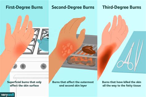 How To Soothe Burns - Treatbeyond2