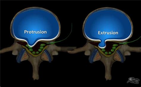 Lumbar Disc Protrusion Mri