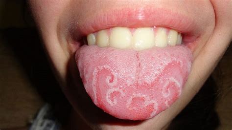 Do You Have A Geographic Tongue?