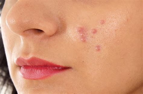 Hard pimples: Treatment, prevention, and causes