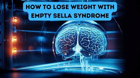 How to Lose Weight With Empty Sella Syndrome