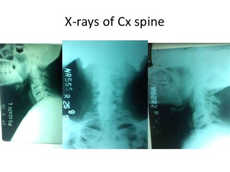 Diffuse idiopathic skeletal hyperostosis