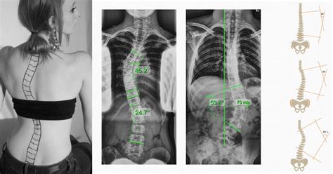 Exploring Scoliosis Curve Types: Key Facts Revealed | Treating Scoliosis