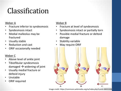 Weber Ankle Fractures — learnED