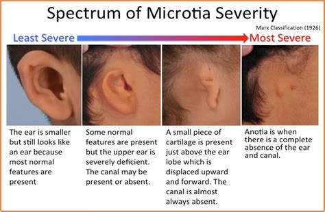 Microtia – Microtia Atresia Malaysia