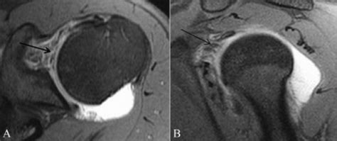 Rotator cuff interval (RCI) tear. Axial TSE T1W fatsatu | Open-i