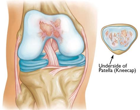 Patellofemoral arthritis causes, symptoms, diagnosis, treatment & prognosis