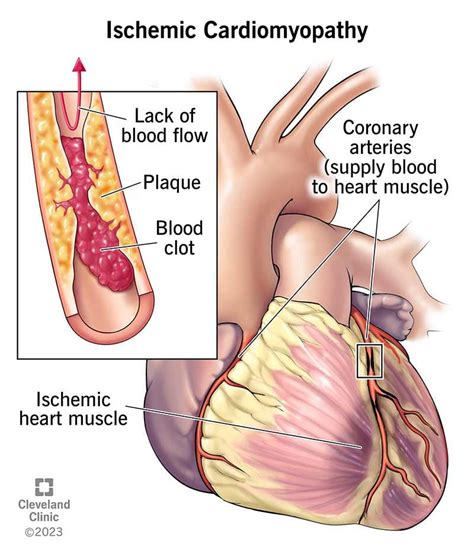 Ischemic Cardiomyopathy: Symptoms Causes | edu.svet.gob.gt