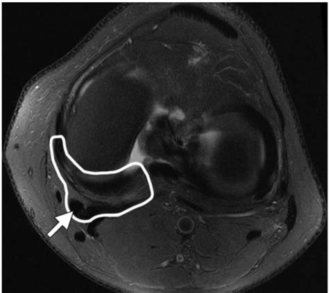 Posteromedial Corner Injury - Knee & Sports - Orthobullets