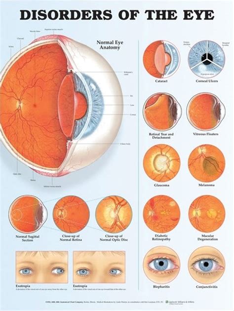 Anatomical Eye Chart, Disorders of the Eye