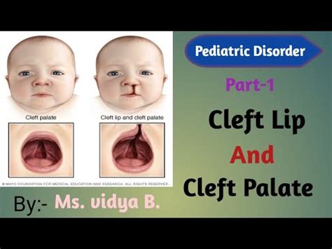 Cleft lip and cleft palate || causes | symptoms | diagnostic test | treatment | pediatrics ...