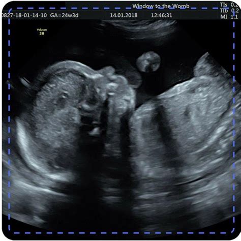 🌟 💥 At Window To The Womb 💥 🌟 💟 We Are Proud Of Our 99.9% Accurate Gender Confirmation 💟 We Are ...