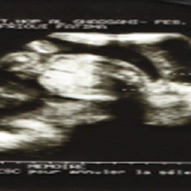 Obstetric ultrasound image showing a pregnancy at 23 weeks of... | Download Scientific Diagram