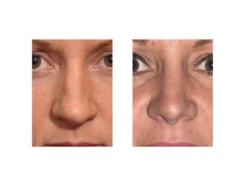 Plastic Surgery Case Study - Large Nose Female Rhinoplasty - Explore Plastic Surgery