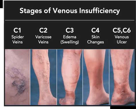 5 Best Treatment for Venous Stasis Ulcers - Luxeveins