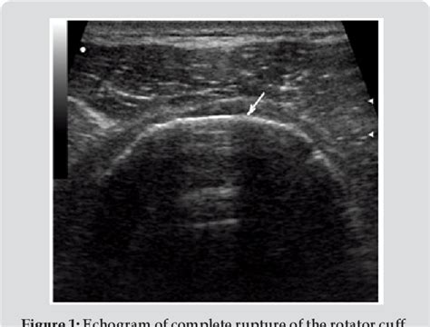 Figure 1 from Ultrasound Diagnosis of Complete Rotator Cuff Tear | Semantic Scholar