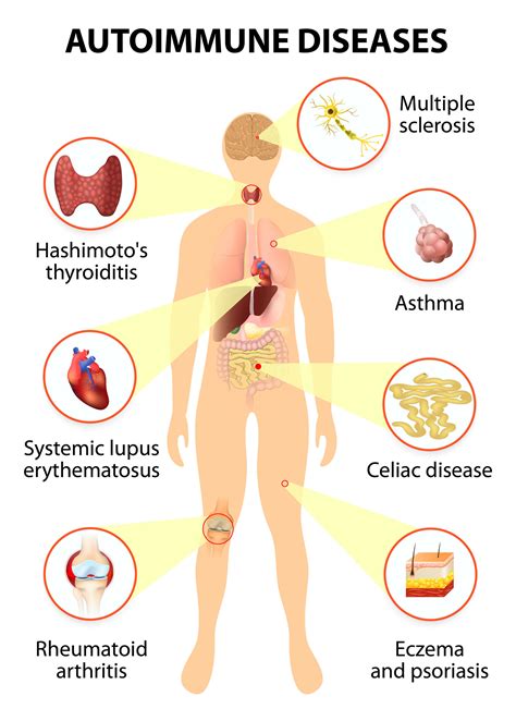 What are autoimmune diseases — Go Beyond Physical Therapy