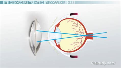 Convex Lens | Definition, Equation & Types - Video & Lesson Transcript ...