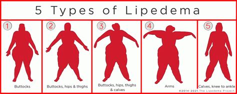 Diagnosis – Premier Lipedema Clinic