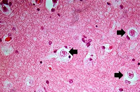 IPLab:Lab 8:HSV Encephalitis - Pathology Education Instructional Resource