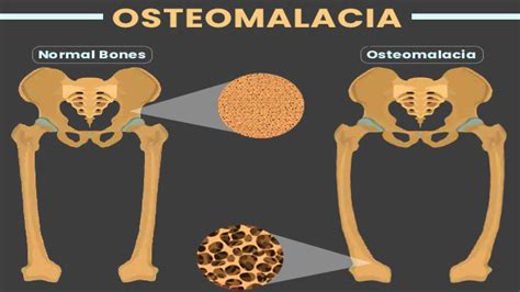 Osteomalacia: Causes, Symptoms, Risk Factors, Diagnosis & Treatment ...