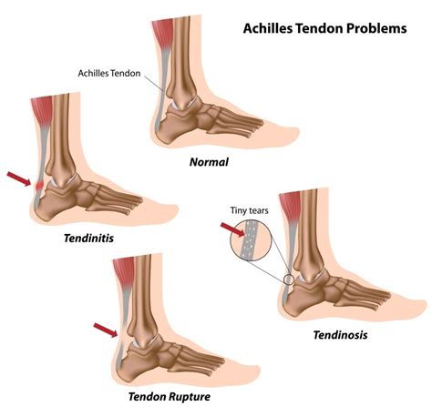 Achilles Tendinosis - Jing Advanced Massage Training