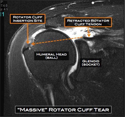 Shoulder Surgery Austin, TX | Rotator Cuff Repair Cedar Park | Round Rock