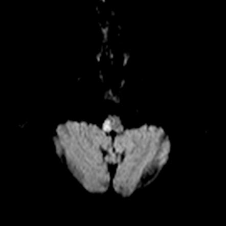 Brainstem stroke syndromes | Radiology Reference Article | Radiopaedia.org