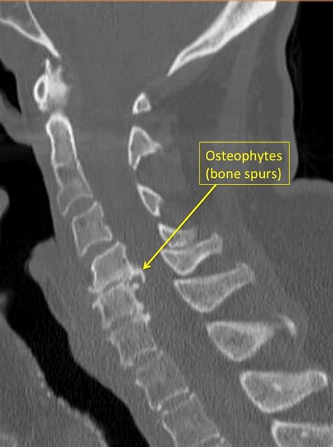 Bone Spurs In The Neck Area Of The Spine