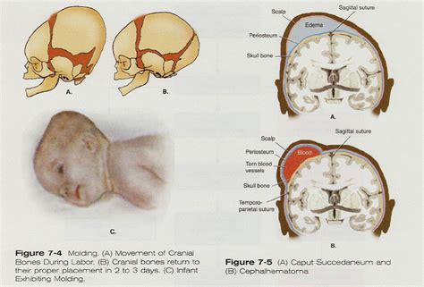 Caput Succedaneum Ultrasound