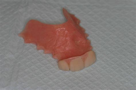 Flipper (interim denture) - Advanced Dentistry & Dental Implant Center