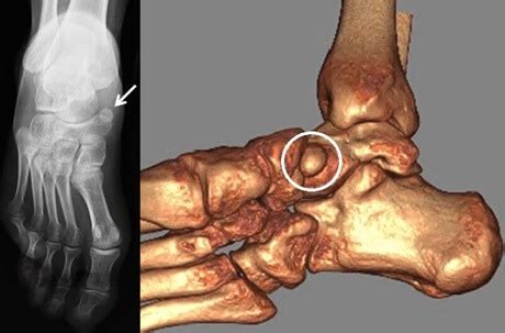 Accessory Navicular Bone Pain: Causes, Symptoms & Treatment