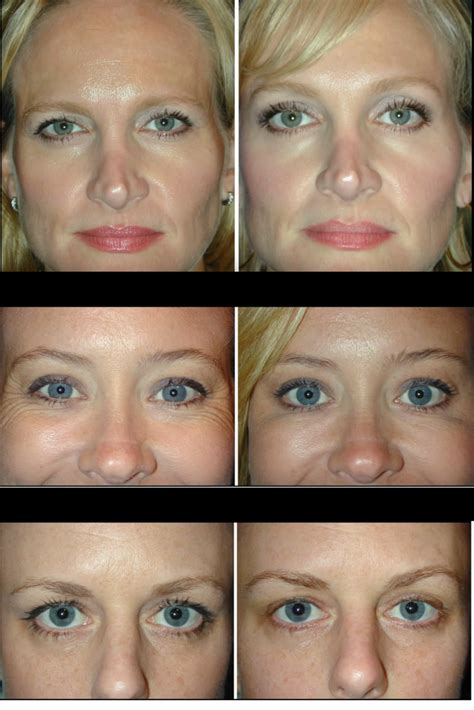 Botox Between Eyebrows Before And After - EyebrowShaper