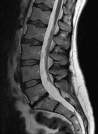 Thoracic and Lumbar Spondylosis | Neupsy Key