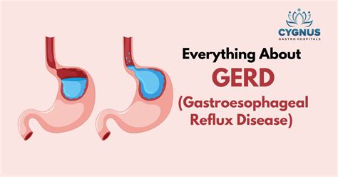 GERD: Risk Factors, Symptoms, Diagnosis and Treatment - Cygnus Gastro Hospitals Hyderabad