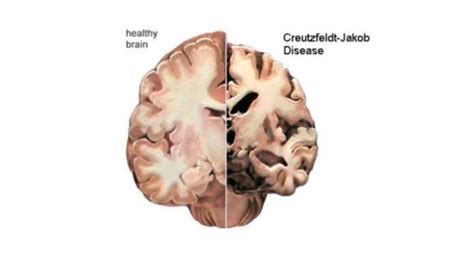 CJD- Creutzfeldt Jakob's Disease