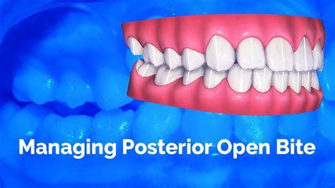 [Premium] Managing Posterior Open Bite - Invisalign Immersion