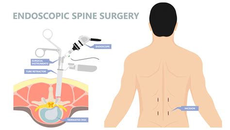 endoscopic spine surgery in india