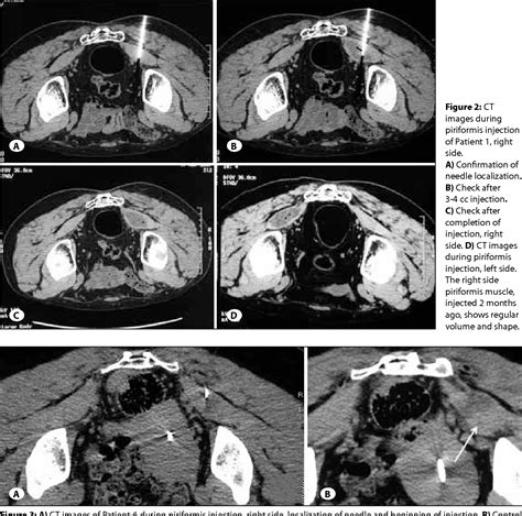 Piriformis Syndrome Injection